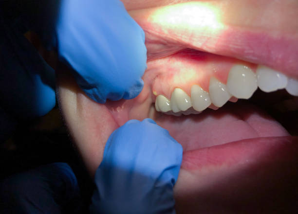 Best Emergency Treatment for Dental Infections or Abscesses in Huachuca City, AZ